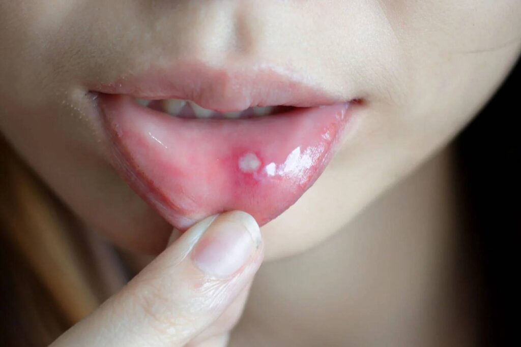 Canker sores, causes and treatment