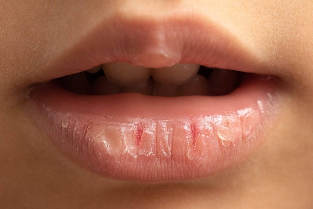 What is the cause of chapped lips and how is it treated?
